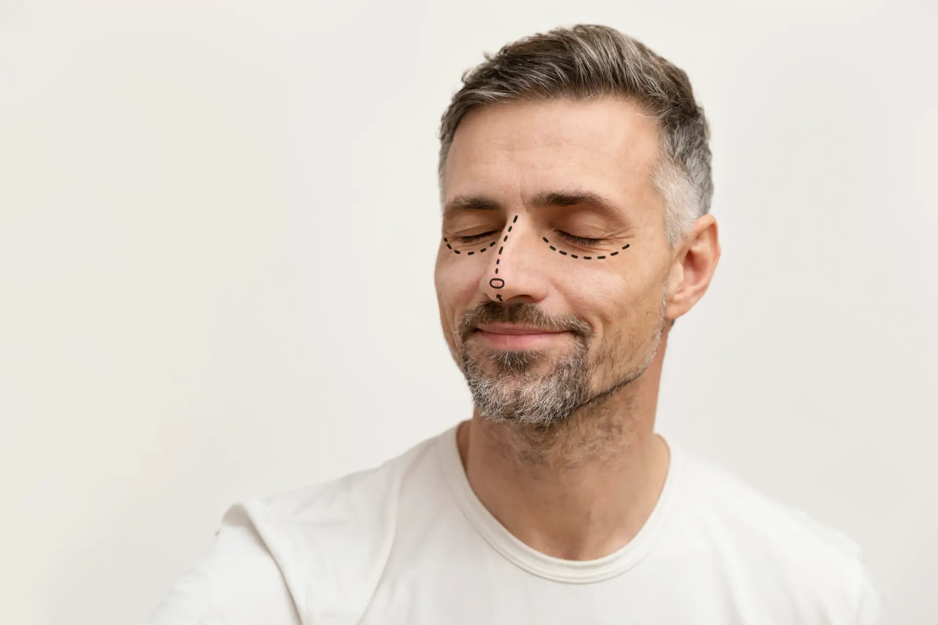 Male Rhinoplasty