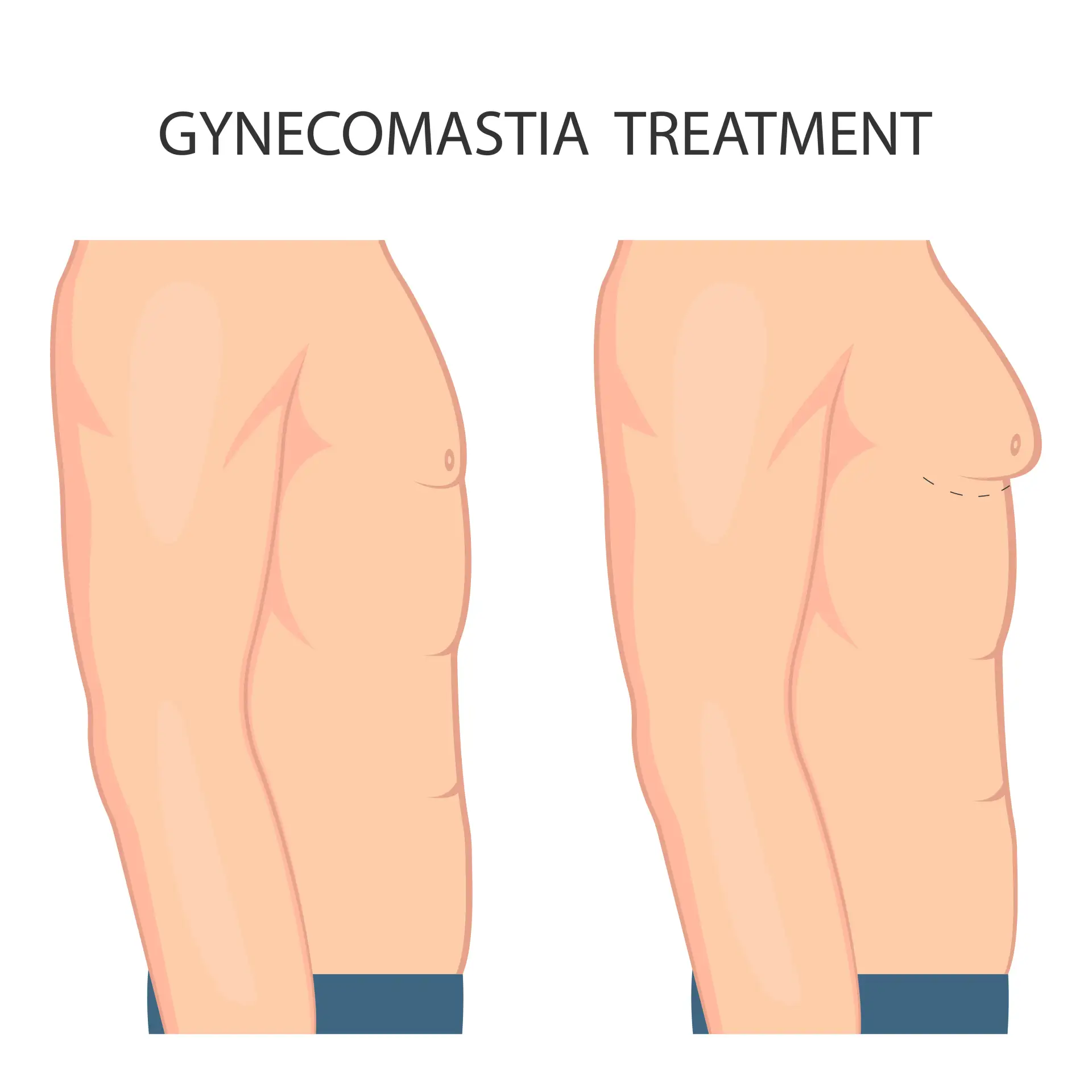 imaging-tests-gynecomastia