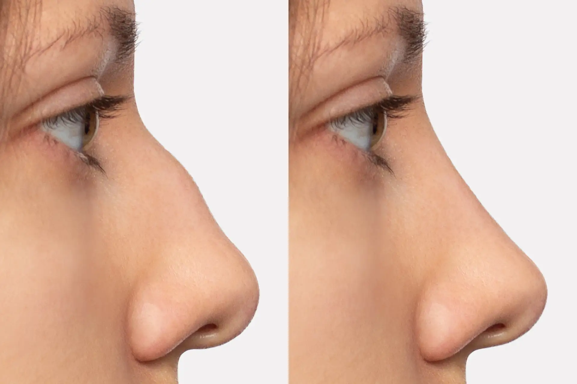 Enhancing-nasal-shape
