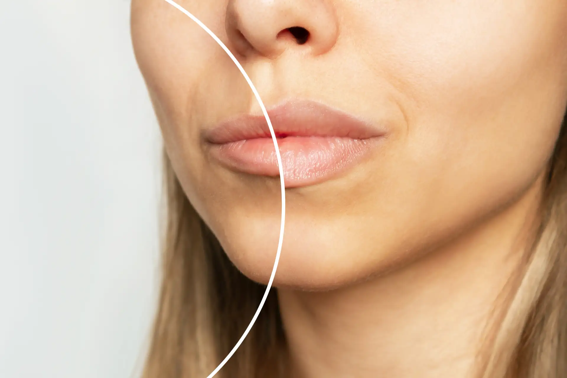 about-lip-fillers