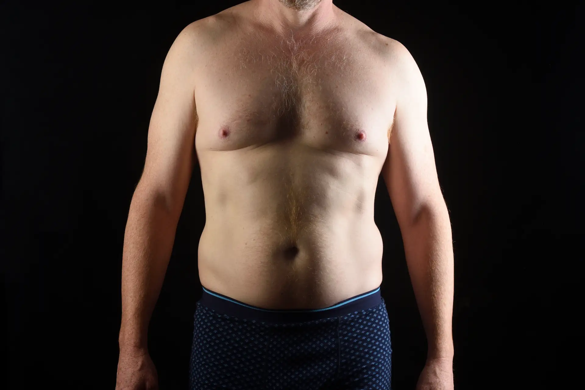 what-are-symptoms-gynecomastia