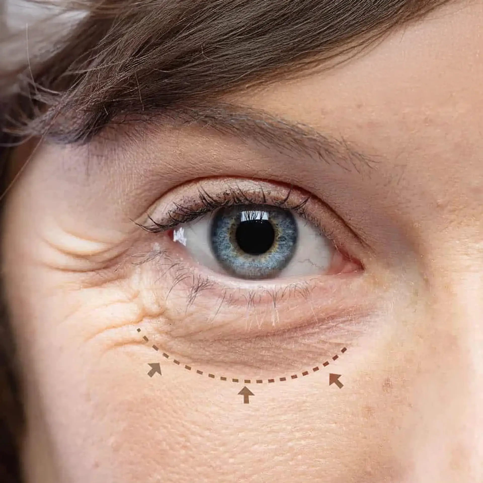 aesthetic-concerns-can-under-eye