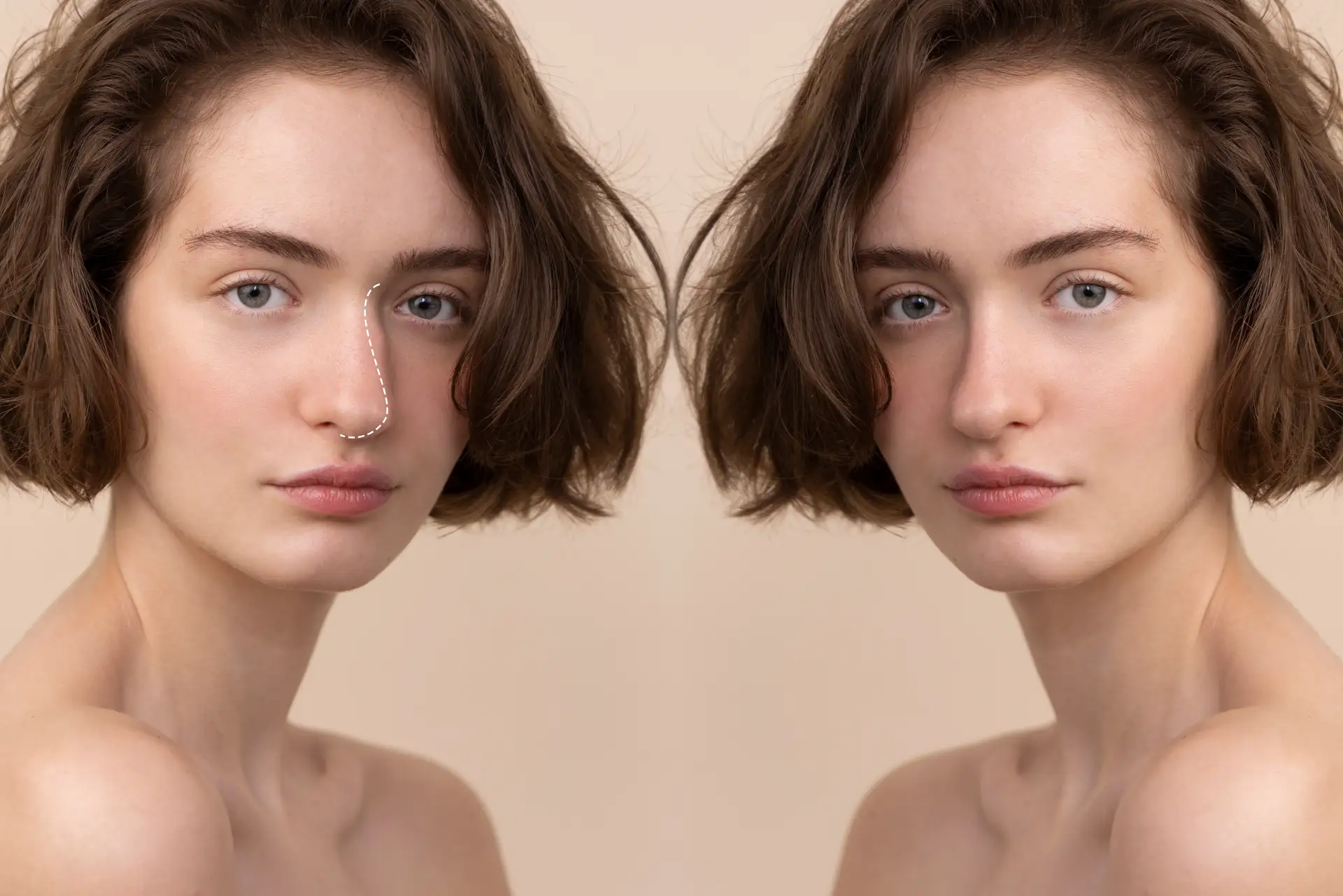 What-Rhinoplasty