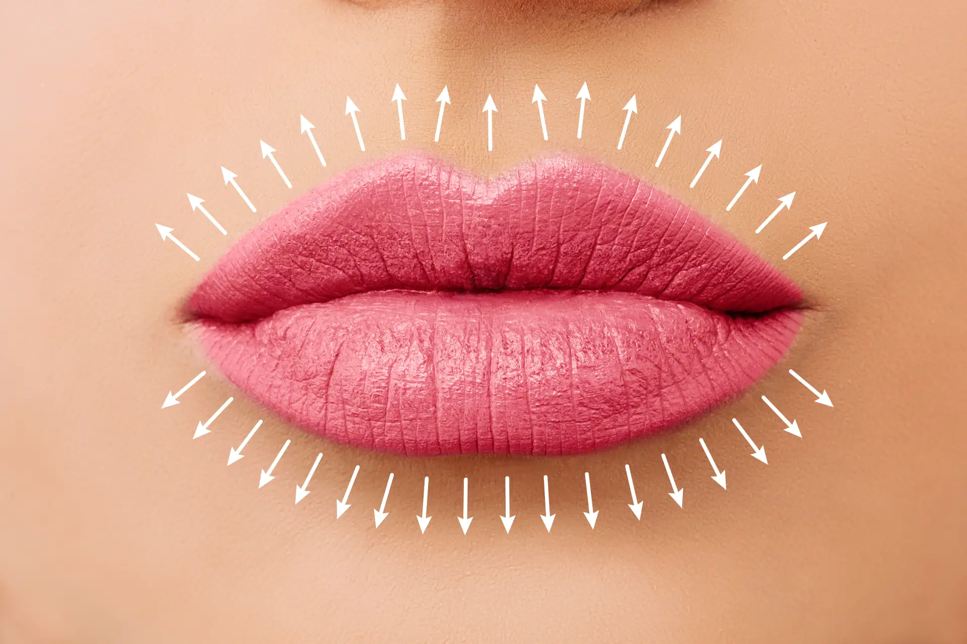 Lip Fillers