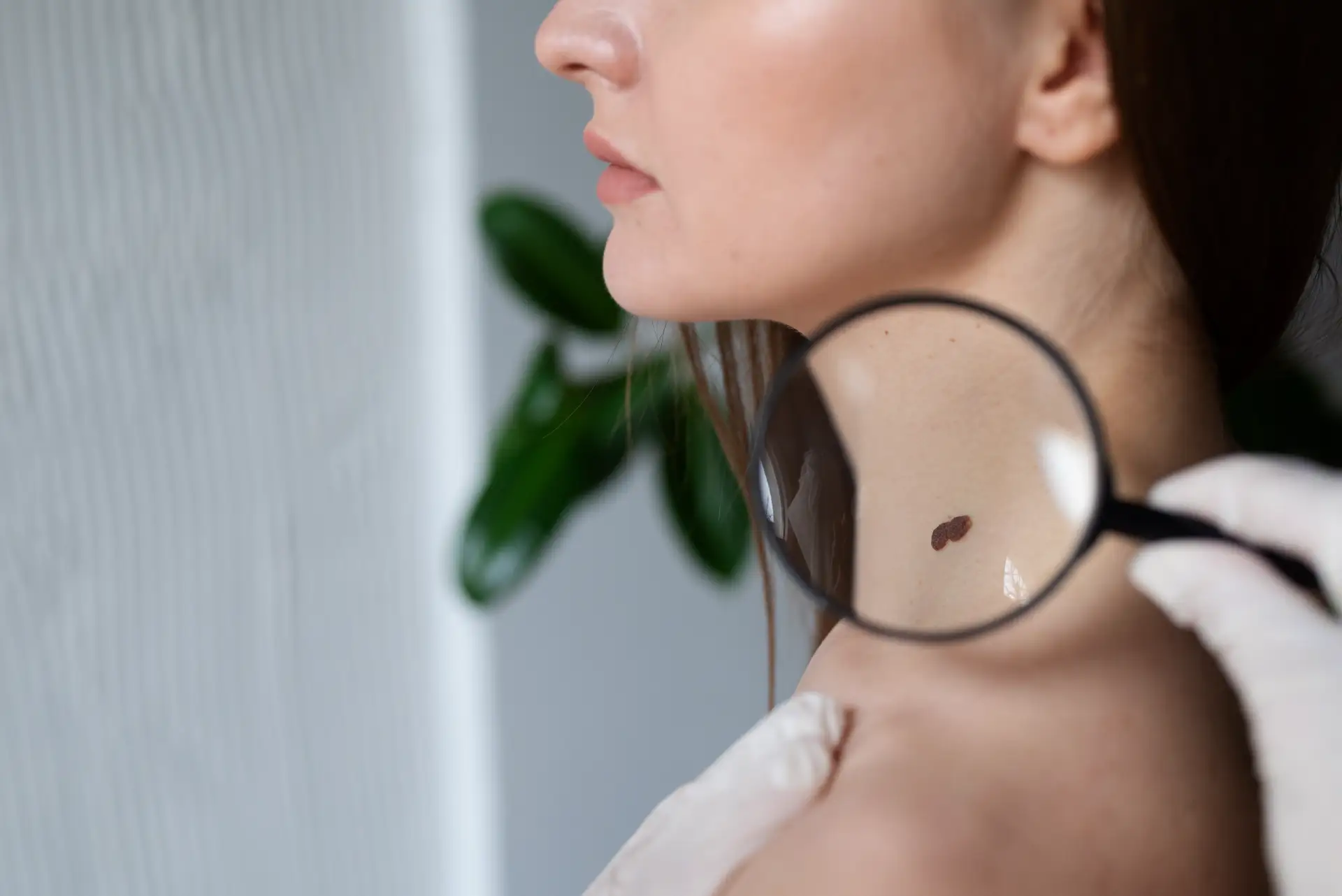 mole-removal
