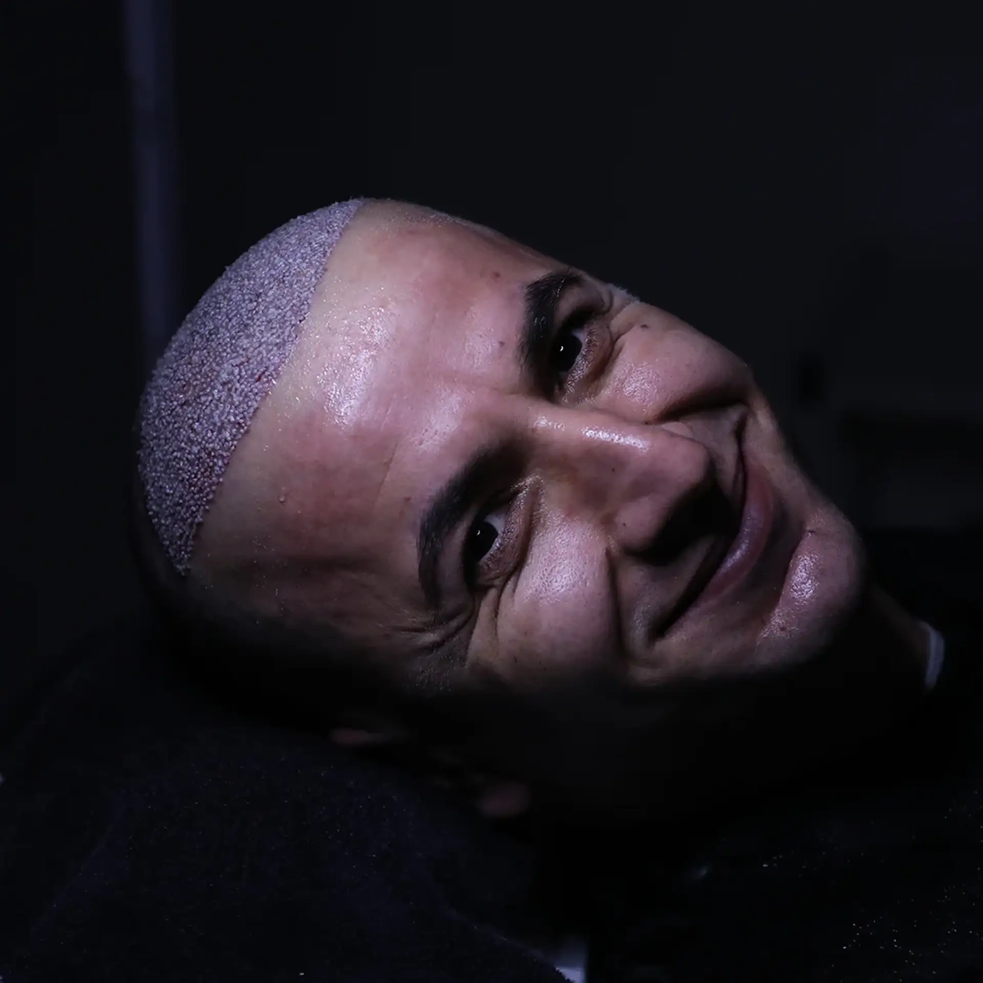 organic-hair-transplantation