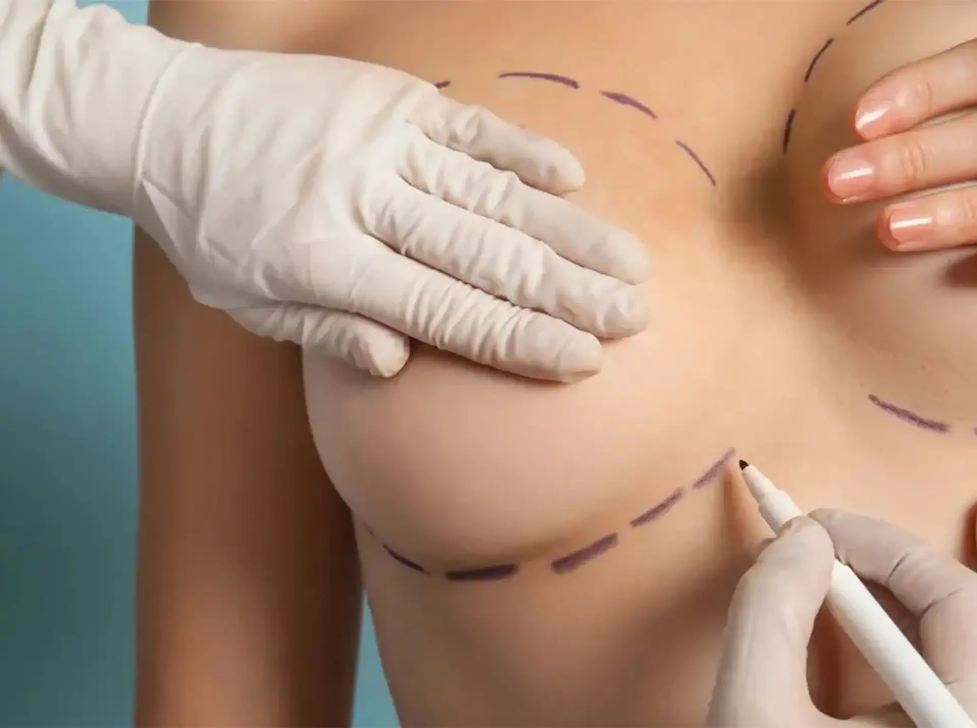 breastfeed-after-breast-reduction