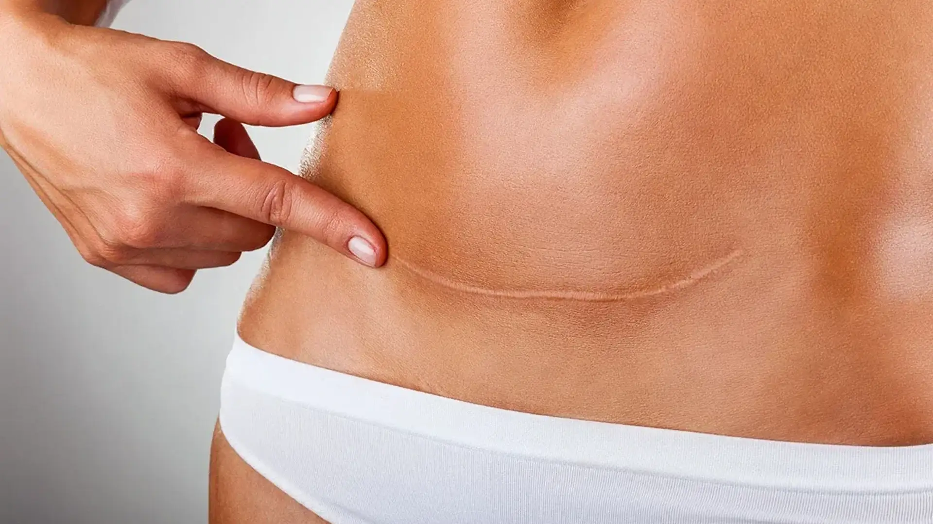 what-is-abdominoplasty