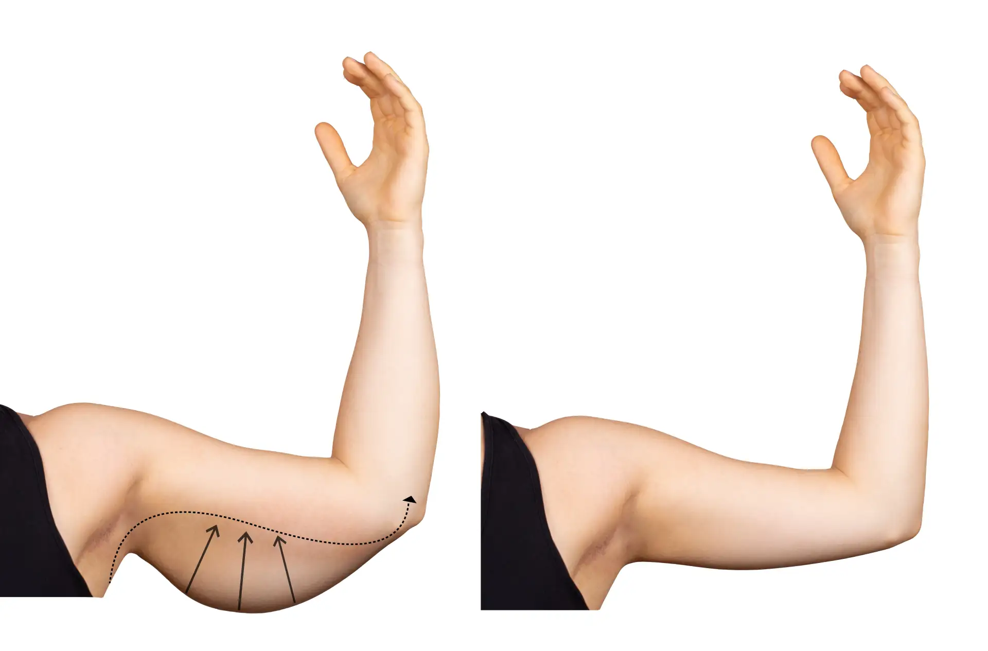 candidate-arm-lift