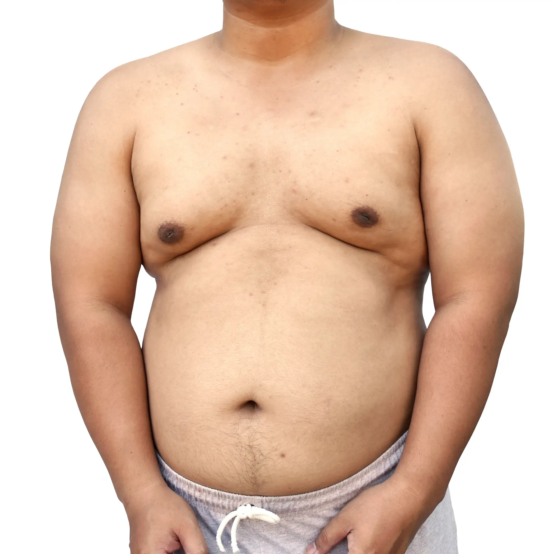 what-is-gynecomastia