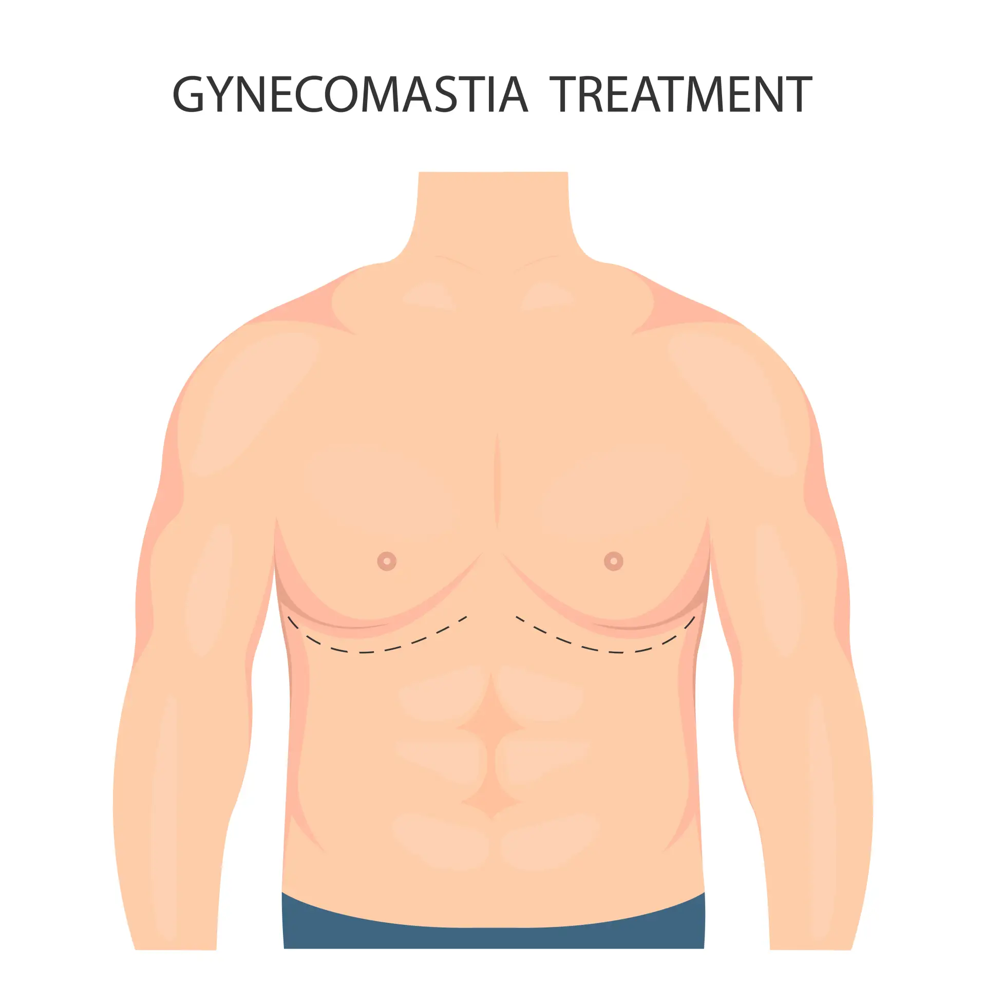 Gynecomastia