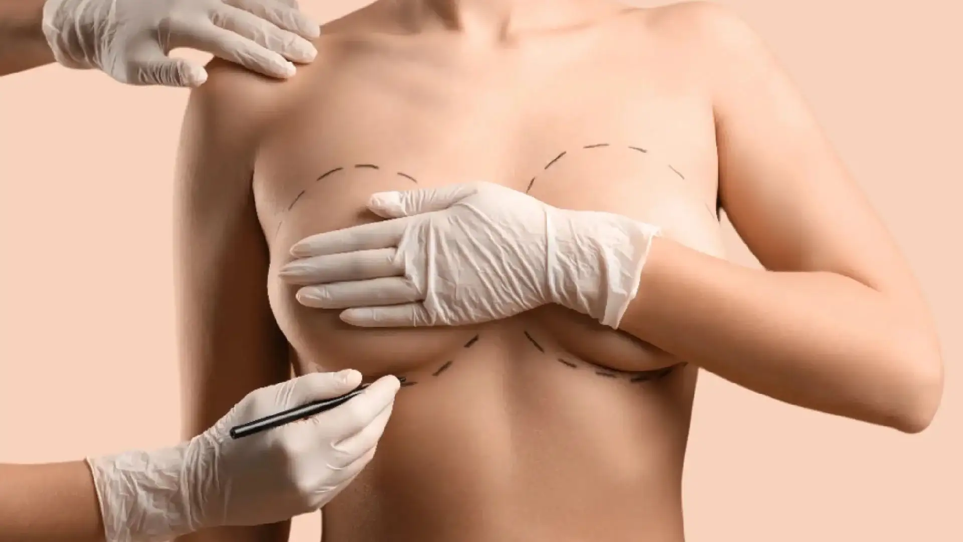 breast-augmentation