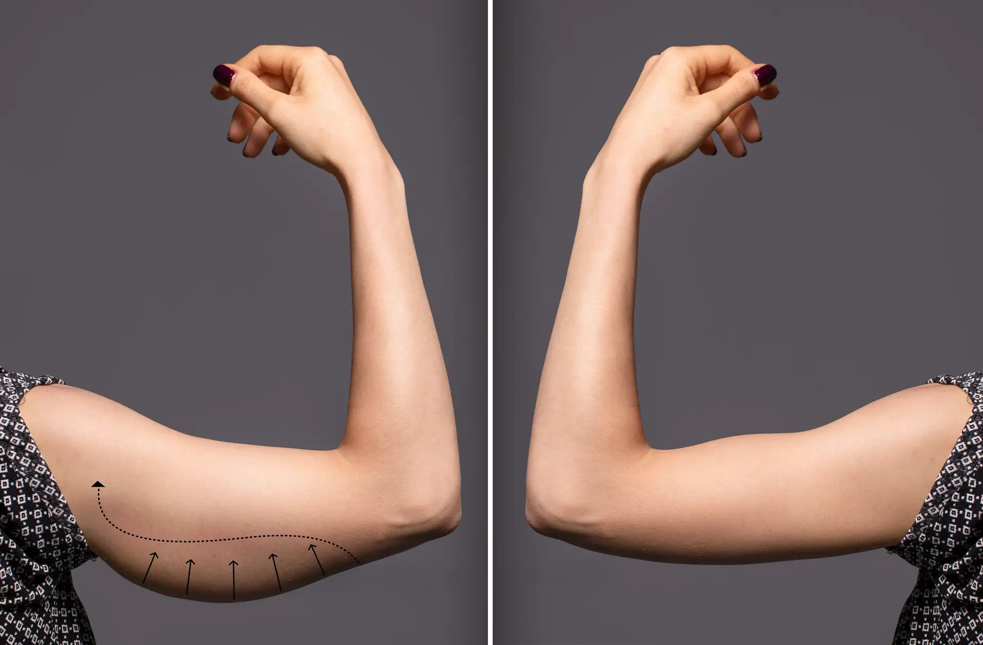 benefits-arm-lift