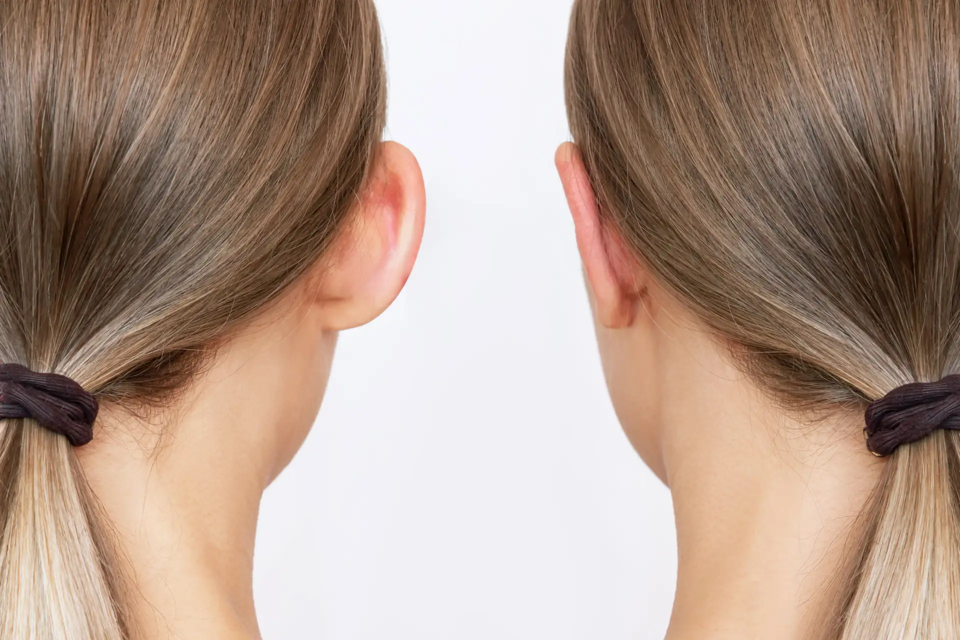 otoplasty-luneste