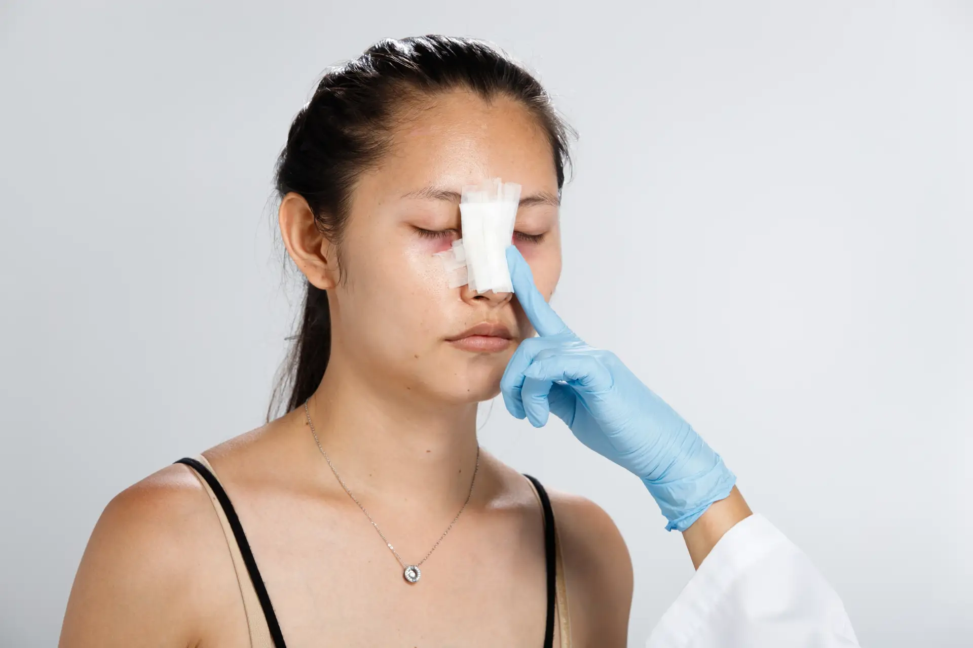 Secondary-Rhinoplasty