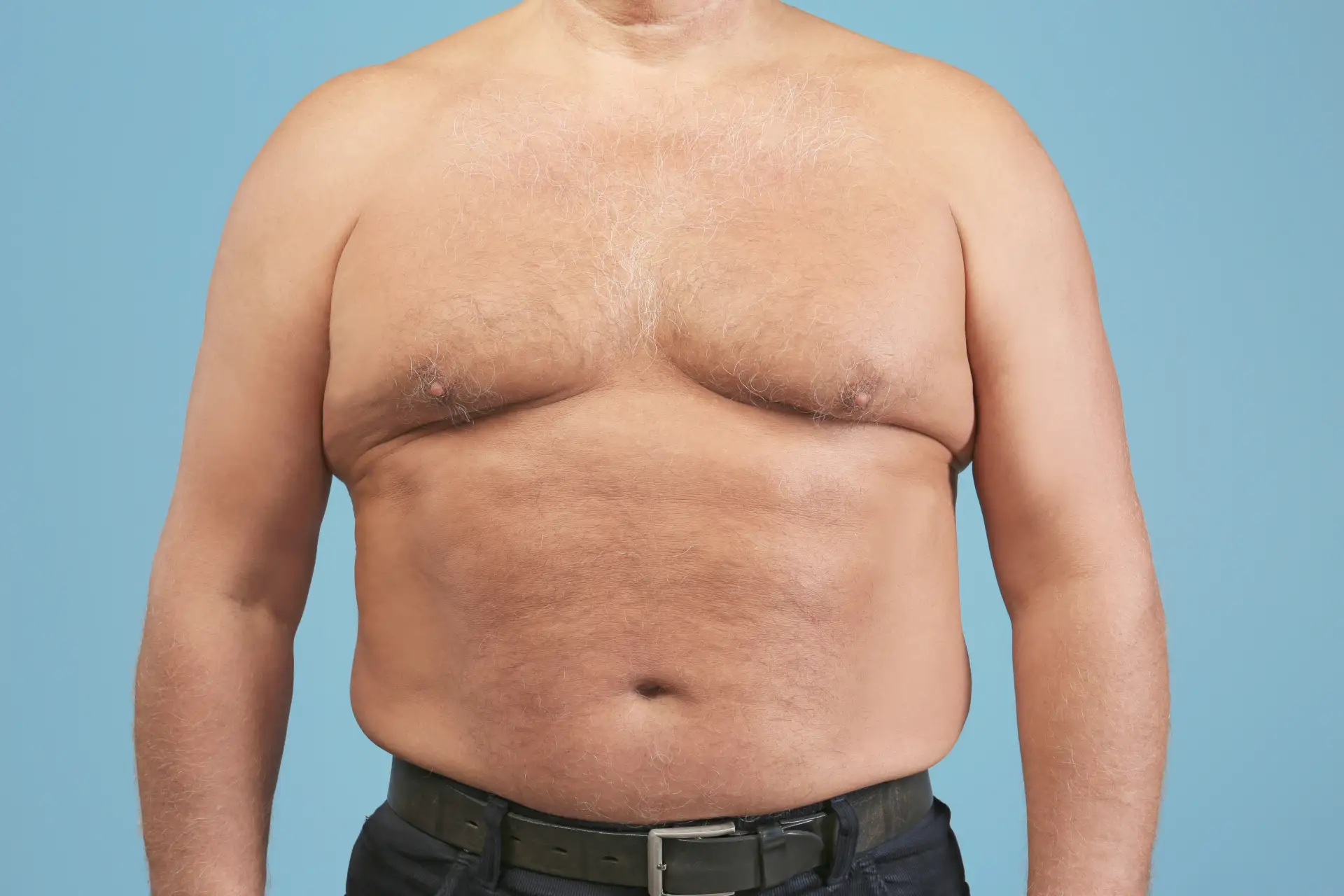 what-are-different-types-gynecomastia
