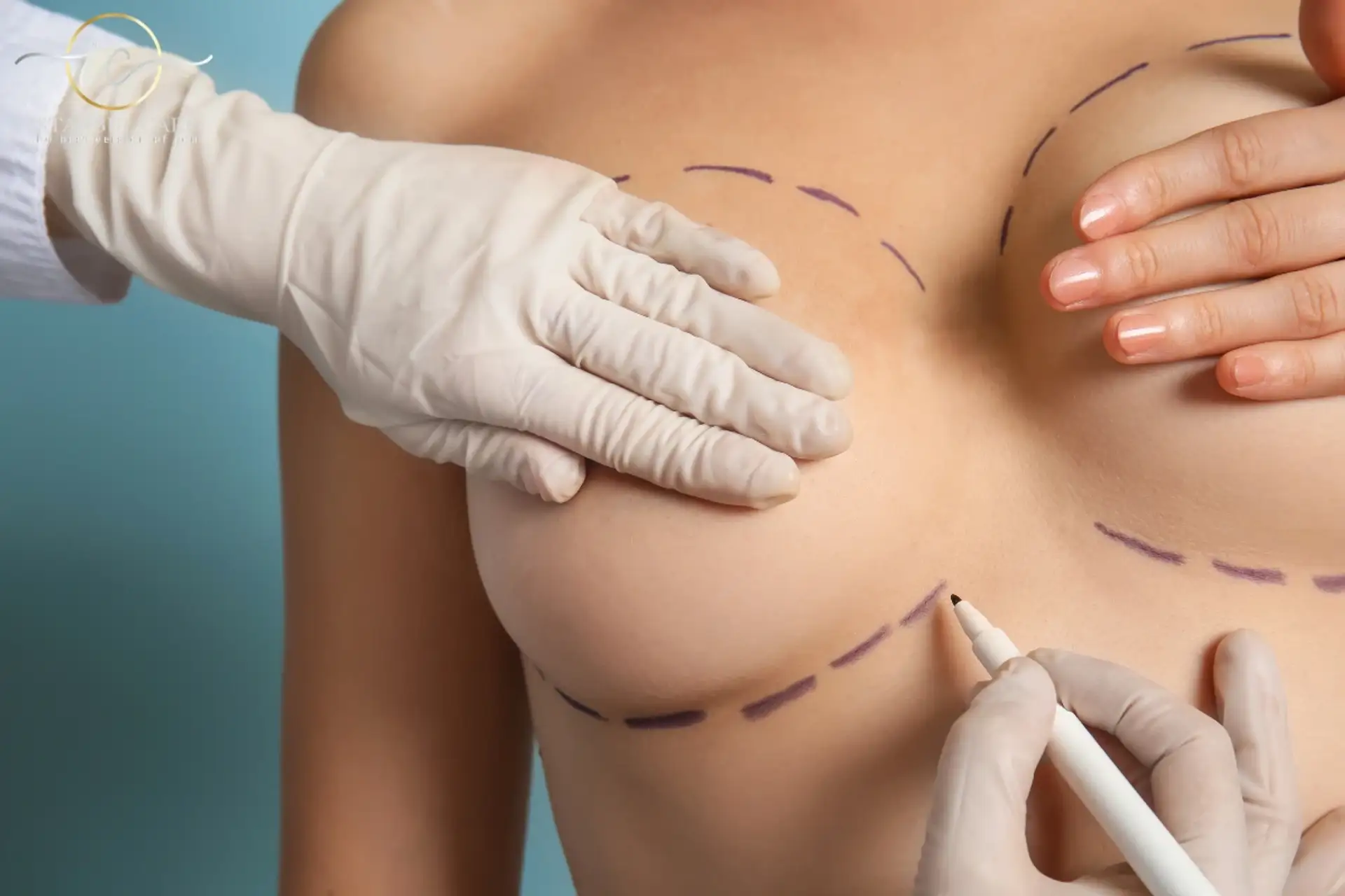 Breast Lift in Turkey Cost: All You Need to Know