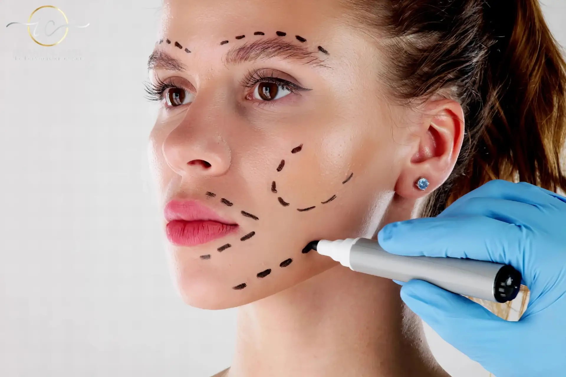 Essential Insights on Facelift Surgery in Turkey