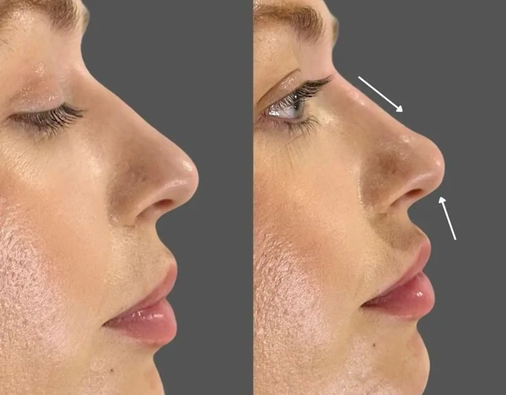 Rhinoplasty in Istanbul: Get a Nose Surgery in Turkey